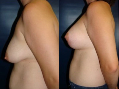 mastopexy 5-2