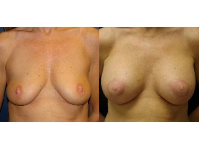 mastopexy-6-1 copy