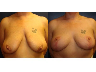 mastopexy 6-1