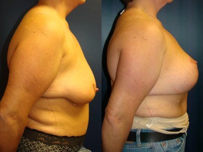 mastopexy 6-2