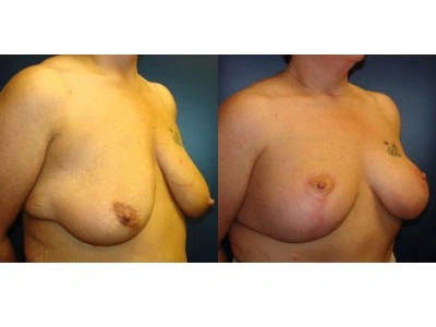 mastopexy 6-3