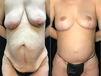 mastopexy-abdominoplasty-with-diastasis-repair 11-1