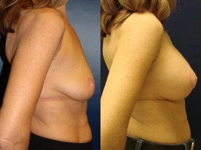 mastopexy-breast-lift 10-2