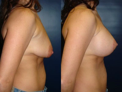 mastopexy-breast-lift 11-2