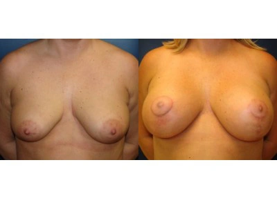 mastopexy-breast-lift 12-1