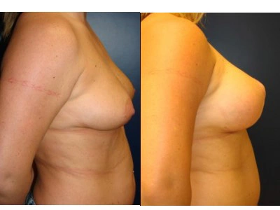 mastopexy-breast-lift 12-2