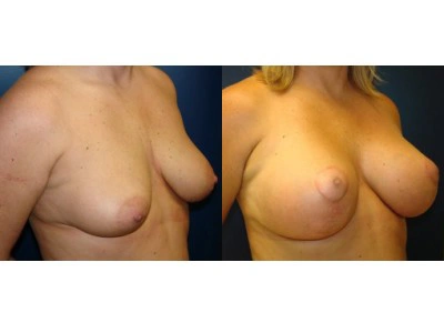 mastopexy-breast-lift 12-3