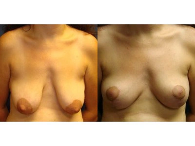mastopexy-breast-lift 7-1