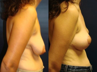 mastopexy-breast-lift 7-2