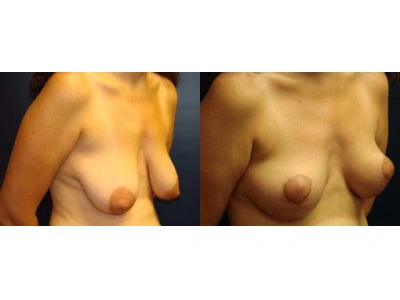 mastopexy-breast-lift 7-3