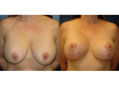 mastopexy-breast-lift 8-1