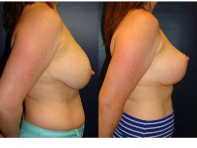 mastopexy-breast-lift 8-2