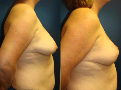 mastopexy-breast-lift 9-2