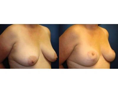 mastopexy-breast-lift 9-3