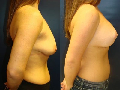 mastopexy-silicone-14-2
