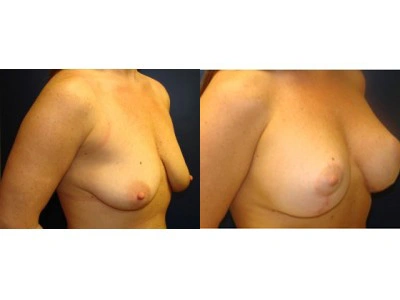 mastopexy-silicone-14-3