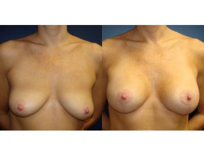 mastopexy-silicone-14-4