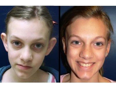 otoplasty 9-1