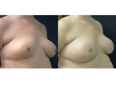saline-breast-augmentation-right-breast-mastopexy-left-breast 15-2