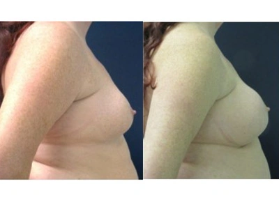 saline-breast-augmentation-right-breast-mastopexy-left-breast 15-3