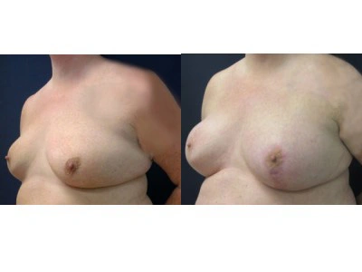 saline-breast-augmentation-right-breast-mastopexy-left-breast 15-4