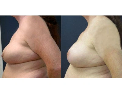 saline-breast-augmentation-right-breast-mastopexy-left-breast 15-5