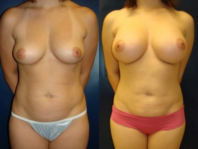 saline-breast-implants-and-liposuction-1site 12-1_