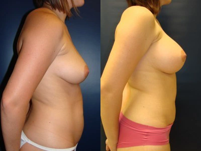 saline-breast-implants-and-liposuction-1site 12-2