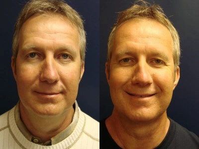 submental-liposuction 7-1