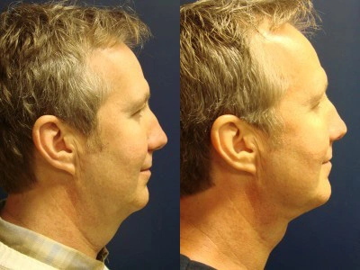 submental-liposuction 7-2