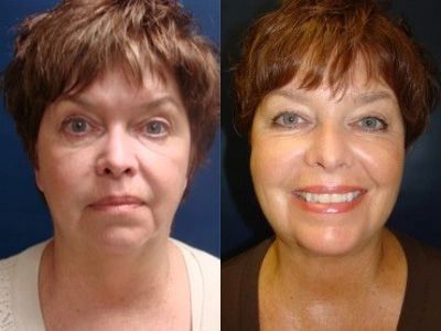 submental-liposuction 8-1