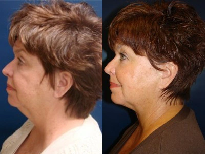 submental-liposuction 8-2