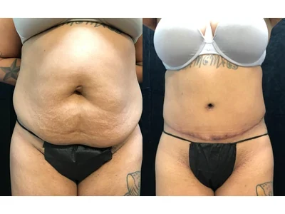 Before and after abdominoplasty, patient case 20004, view 1