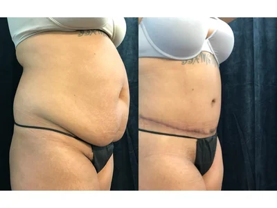 Before and after abdominoplasty, patient case 20004, view 2