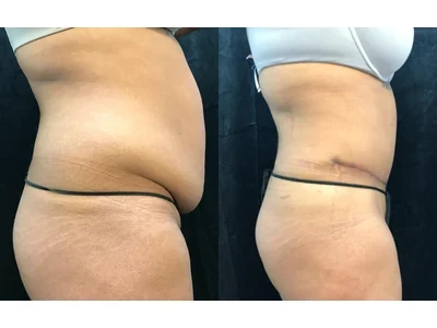 Before and after abdominoplasty, patient case 20004, view 3