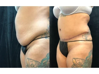 Before and after abdominoplasty, patient case 20004, view 4
