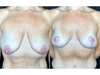 Before and after breast lift, patient case 20005, view 1