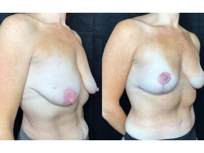 Before and after breast lift, patient case 20005, view 2