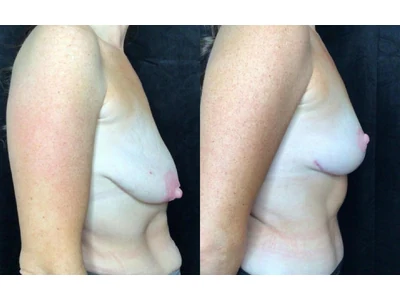 Before and after breast lift, patient case 20005, view 3