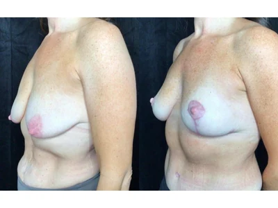 Before and after breast lift, patient case 20005, view 4
