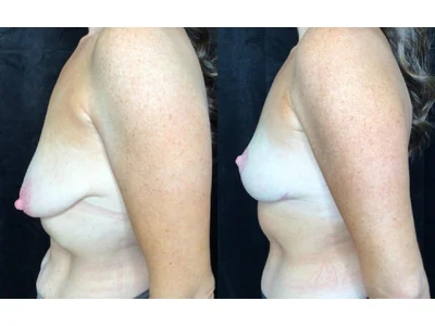 Before and after breast lift, patient case 20005, view 5
