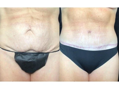 Before and after abdominoplasty, patient case 20006, view 1