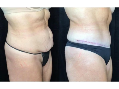 Before and after abdominoplasty, patient case 20006, view 2