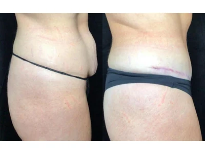 Before and after abdominoplasty, patient case 20006, view 3