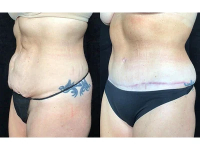 Before and after abdominoplasty, patient case 20006, view 4