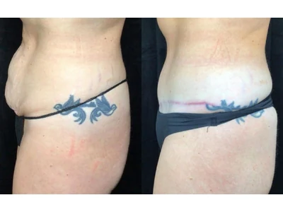 Before and after abdominoplasty, patient case 20006, view 5