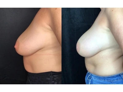 Before and after breast augmentation, patient case 20007, view 5