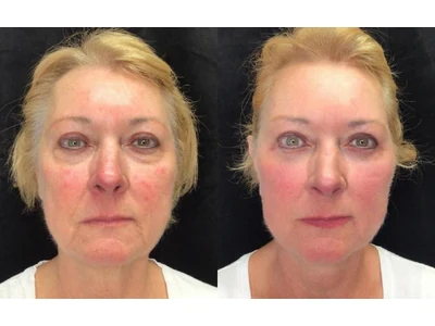 Before and after facelift, patient case 20008, view 1