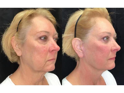 Before and after facelift, patient case 20008, view 2