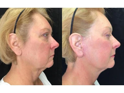 Before and after facelift, patient case 20008, view 3